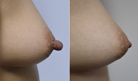 adrian glogowski add photo nipple asia